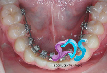 Dentistas en Chamberí Social Dental Studio Madrid ortodoncia lingual copia