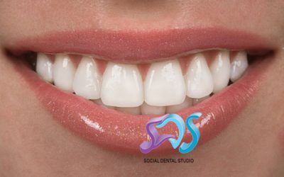 Carillas dentales