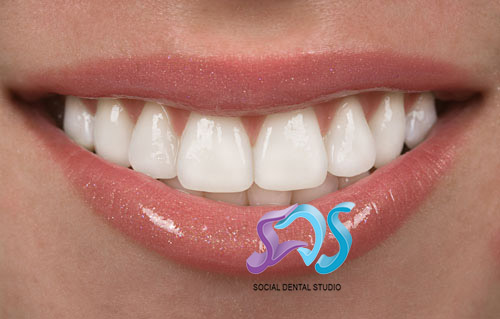Dentistas en Chamberí Social Dental Studio Madrid carillas finas porcelana aguilar dental salut copia