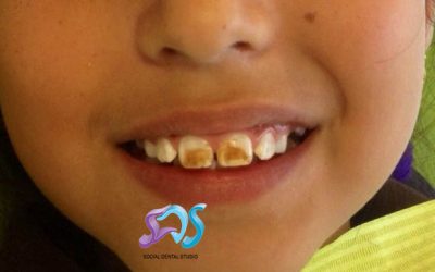 FLUOROSIS