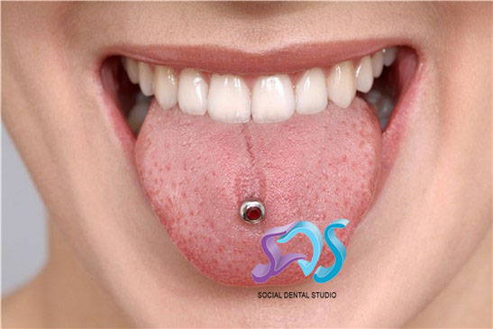 Dentistas en Chamberí Social Dental Studio Madrid piercing bucal copia