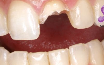 ¿Qué harías si… sufrieras un traumatismo dental?