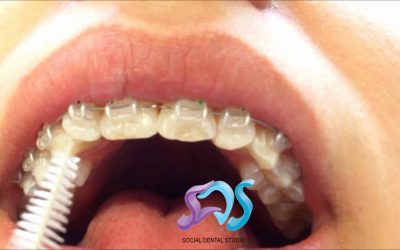 ¿CÓMO CEPILLARME LOS DIENTES SI TENGO APARATOS CON BRACKETS? 