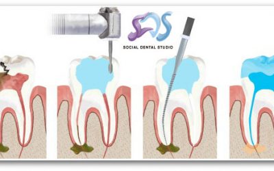 ¿Qué es una endodoncia?