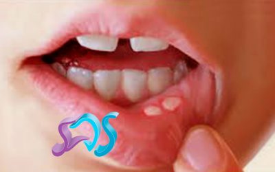 Aftas bucales, causas y tratamiento