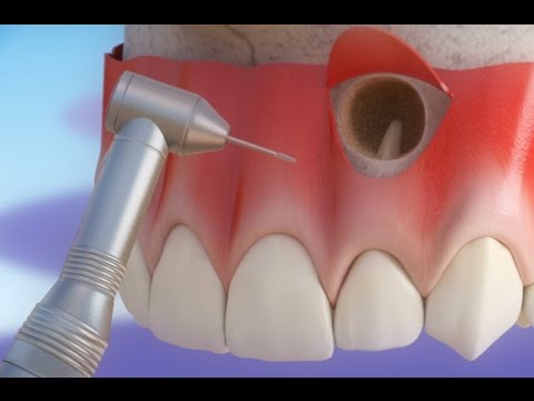 Dentistas en Chamberí Social Dental Studio Madrid apiceptomia
