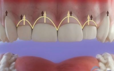 Gingivectomia