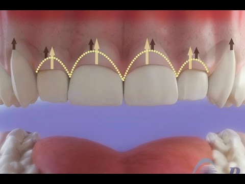 Dentistas en Chamberí Social Dental Studio Madrid gingivectomia