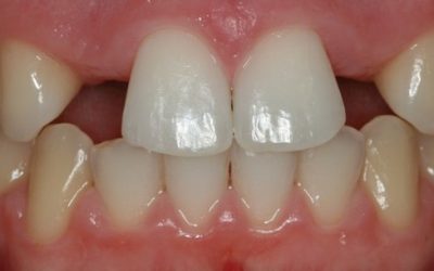 Qué es la agenesia dental?