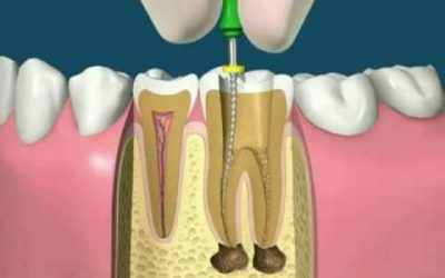 Reendodoncia