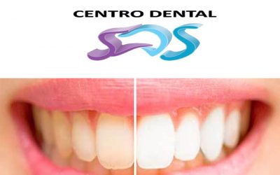 BLANQUEAMIENTO DENTAL