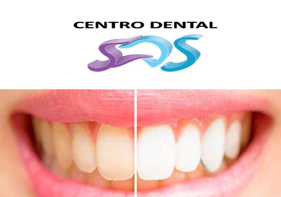 BLANQUEAMIENTO DENTAL