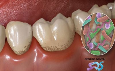 ¿QUE ES Y COMO PREVENIR LA PLACA BACTERIANA?