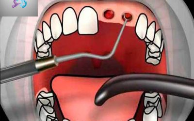 Alveolitis Dental
