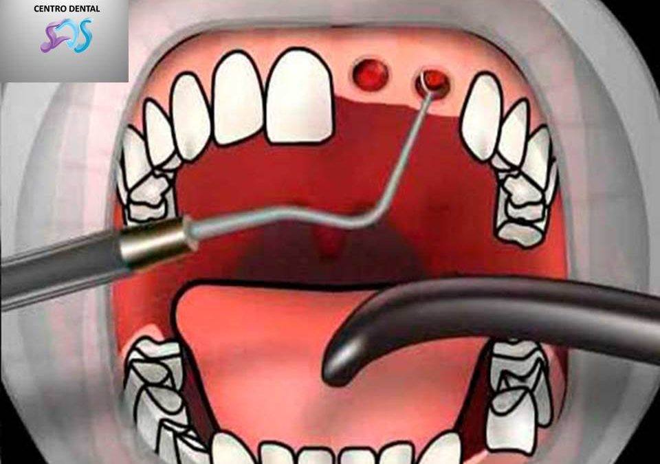 Alveolitis Dental