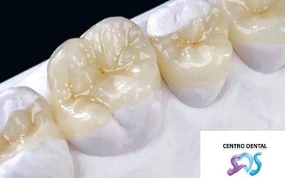 Incrustación Dental