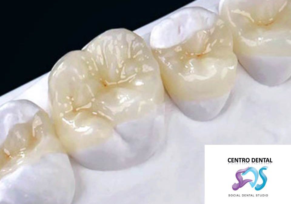Incrustación Dental