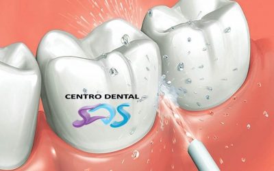 Irrigadores dentales