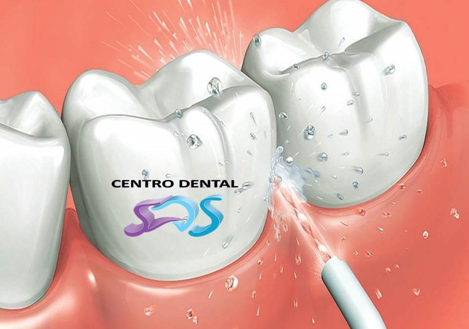 Irrigadores dentales
