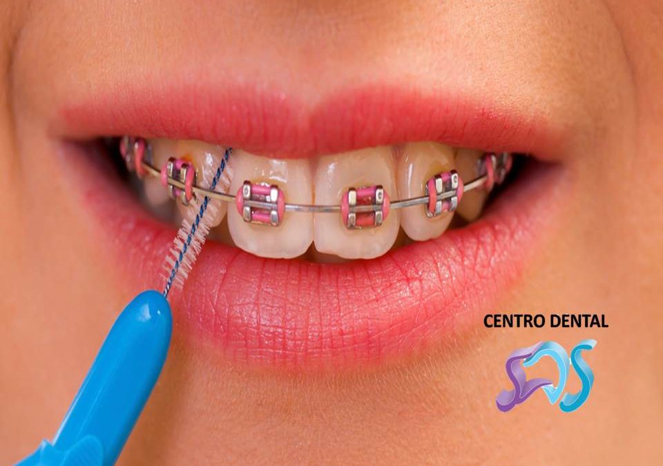 Aprende a limpiar tus brackets