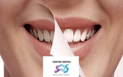 MANCHAS DENTALES TIPOS Y TRATAMIENTOS