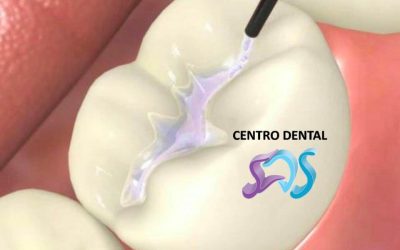 Selladores Dentales