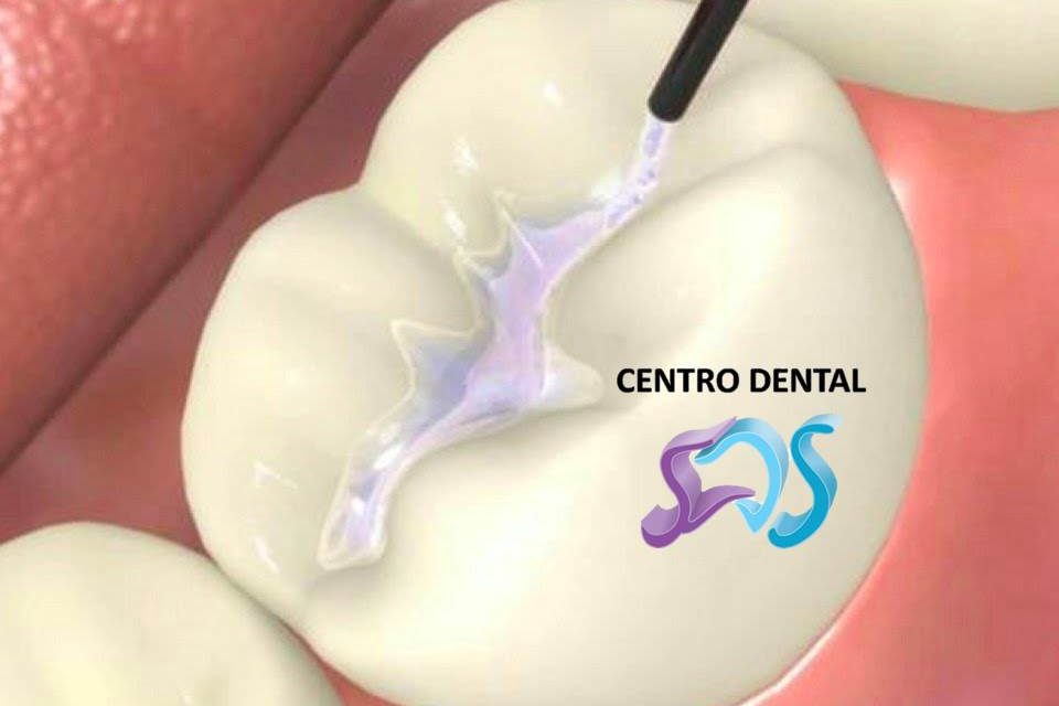 Dentistas en Chamberí Social Dental Studio Madrid SELLADORES