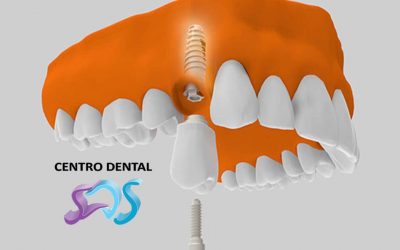 IMPLANTES DENTALES EN UN SOLO DÍA