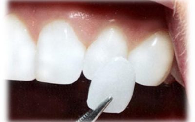 COMO CUIDAR TUS CARILLAS DENTALES