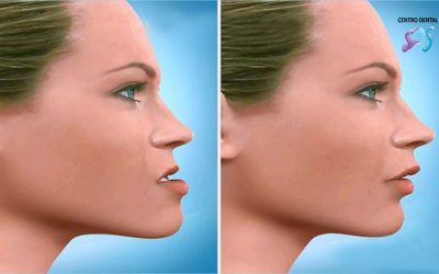 ¿En qué casos necesitarías una cirugía maxilofacial?