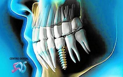 Cuánto tiempo dura un diente con endodoncia