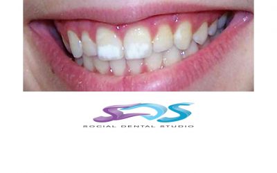 Fluorosis Dental