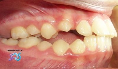 Anquilosis dental