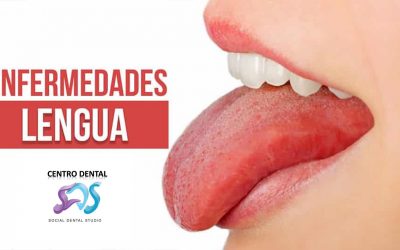 Enfermedades de la lengua y su tratamiento