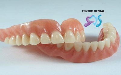 Cómo sujetar la prótesis dental