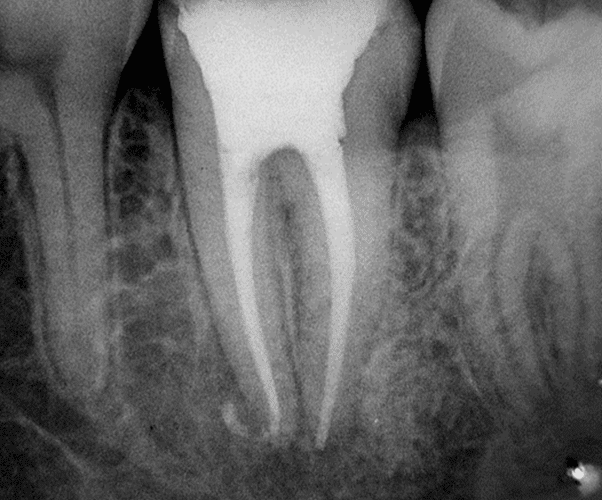 Dentistas en Chamberí Social Dental Studio Madrid foto endodoncia 1 molar