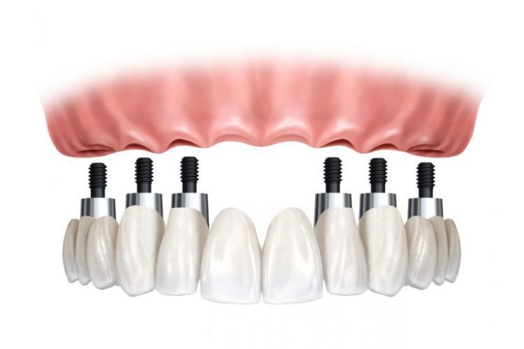 Dentistas en Chamberí Social Dental Studio Madrid protese fixa sobre implantes 768x520