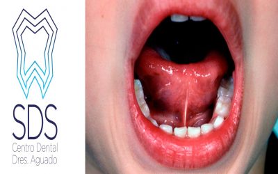 Mi hijo tiene el frenillo lingual corto ¿Qué consecuencias puede  tener?