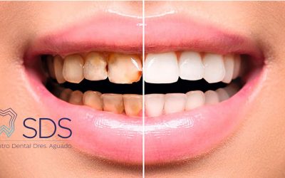 Luce una sonrisa de cine con Carillas Dentales