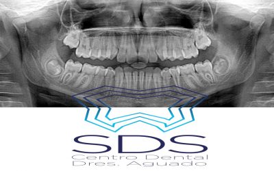¿Son necesarias las Radiografías Dentales? ¿Son peligrosas?