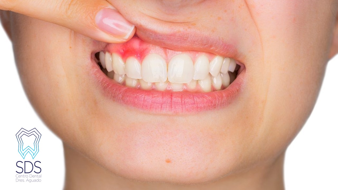 manchas en las encías-clínica dental chamberí