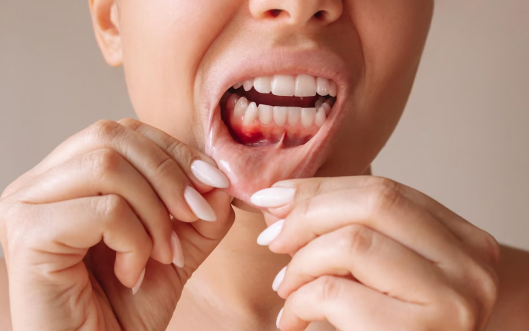 ¿Qué es el curetaje dental y en qué consiste? Todo lo que debes saber sobre el raspado dental