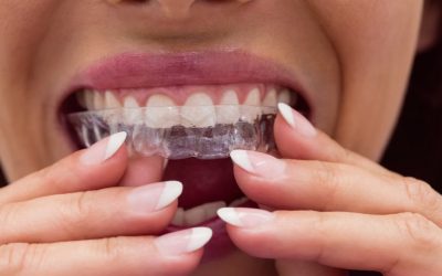 Cómo limpiarte los dientes con retenedores